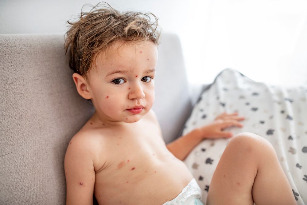 young toddler with chickenpox