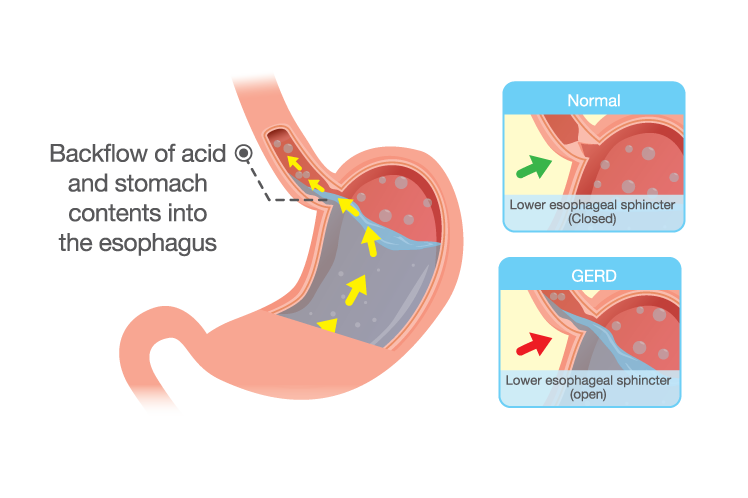 indigestion and acid reflux
