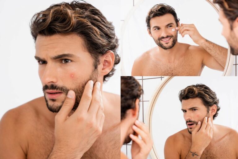 man with acne